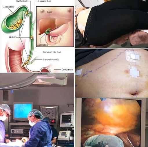 Lap Cholecystectomy in a hypersensitive obese patient